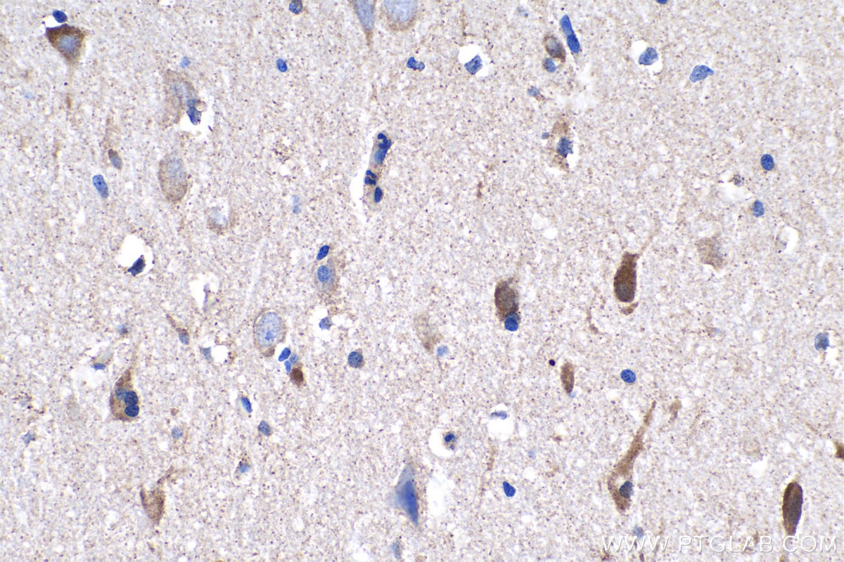 Immunohistochemistry (IHC) staining of human gliomas tissue using ULBP2 Polyclonal antibody (13133-1-AP)