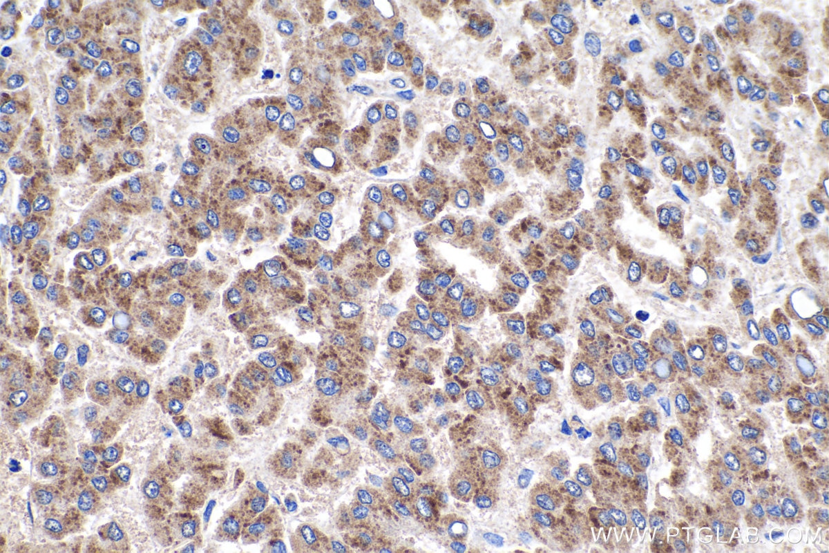 Immunohistochemistry (IHC) staining of human liver cancer tissue using ULBP2 Polyclonal antibody (13133-1-AP)