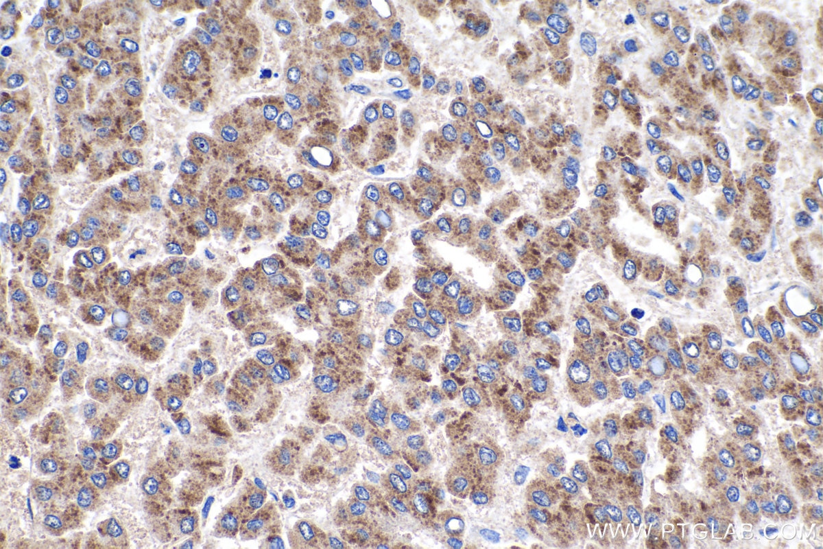 IHC staining of human liver cancer using 13133-1-AP