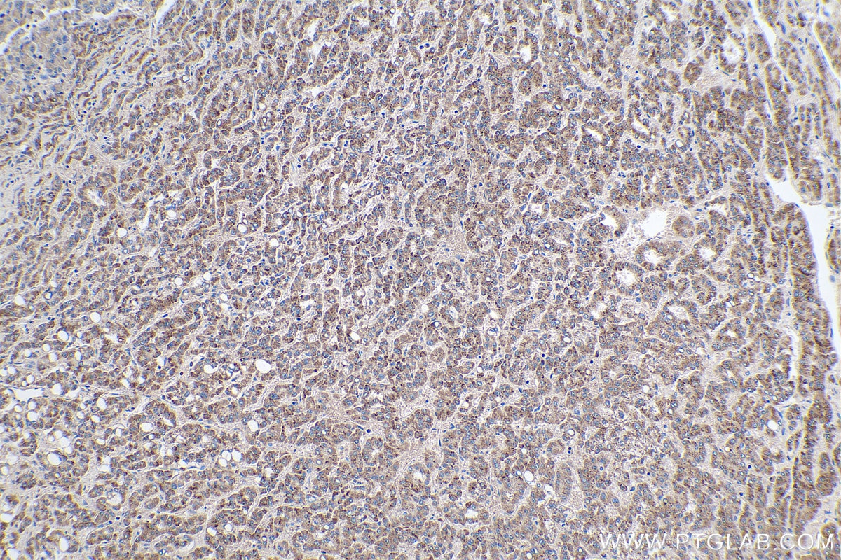 IHC staining of human liver cancer using 13133-1-AP
