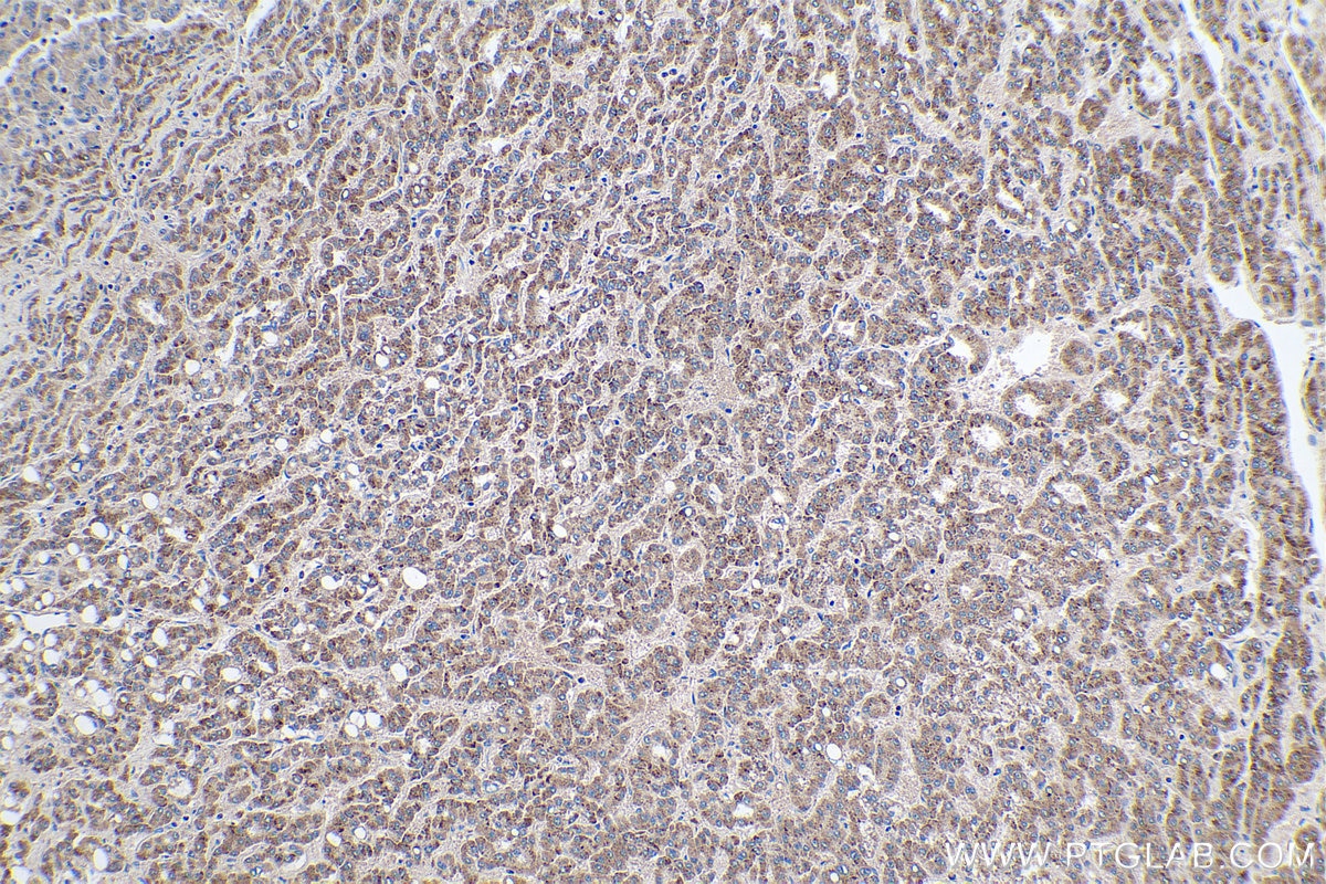 Immunohistochemistry (IHC) staining of human liver cancer tissue using ULBP2 Polyclonal antibody (13133-1-AP)