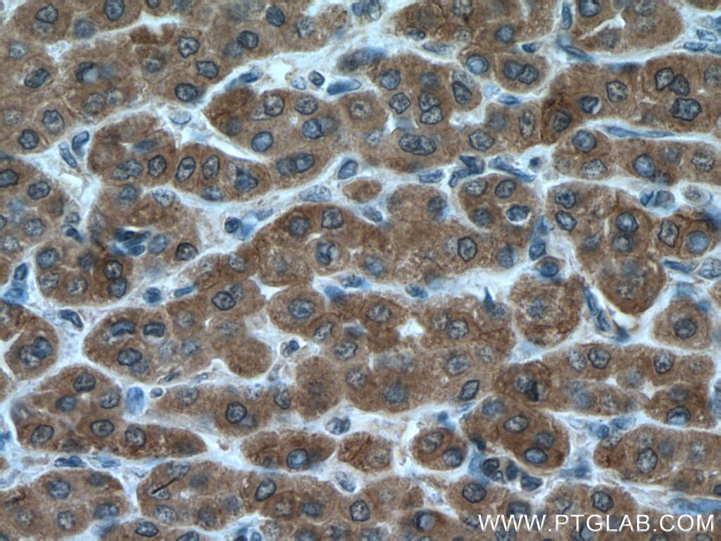 Immunohistochemistry (IHC) staining of human liver cancer tissue using ULK1 Polyclonal antibody (20986-1-AP)