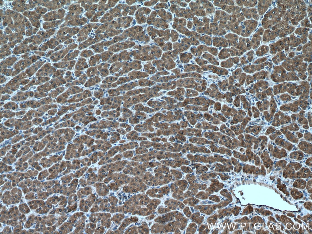 Immunohistochemistry (IHC) staining of human liver cancer tissue using ULK1 Polyclonal antibody (20986-1-AP)