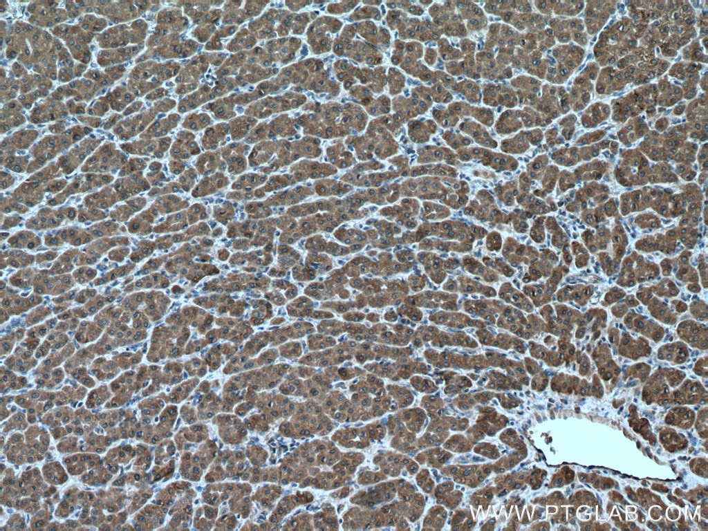 IHC staining of human liver cancer using 20986-1-AP