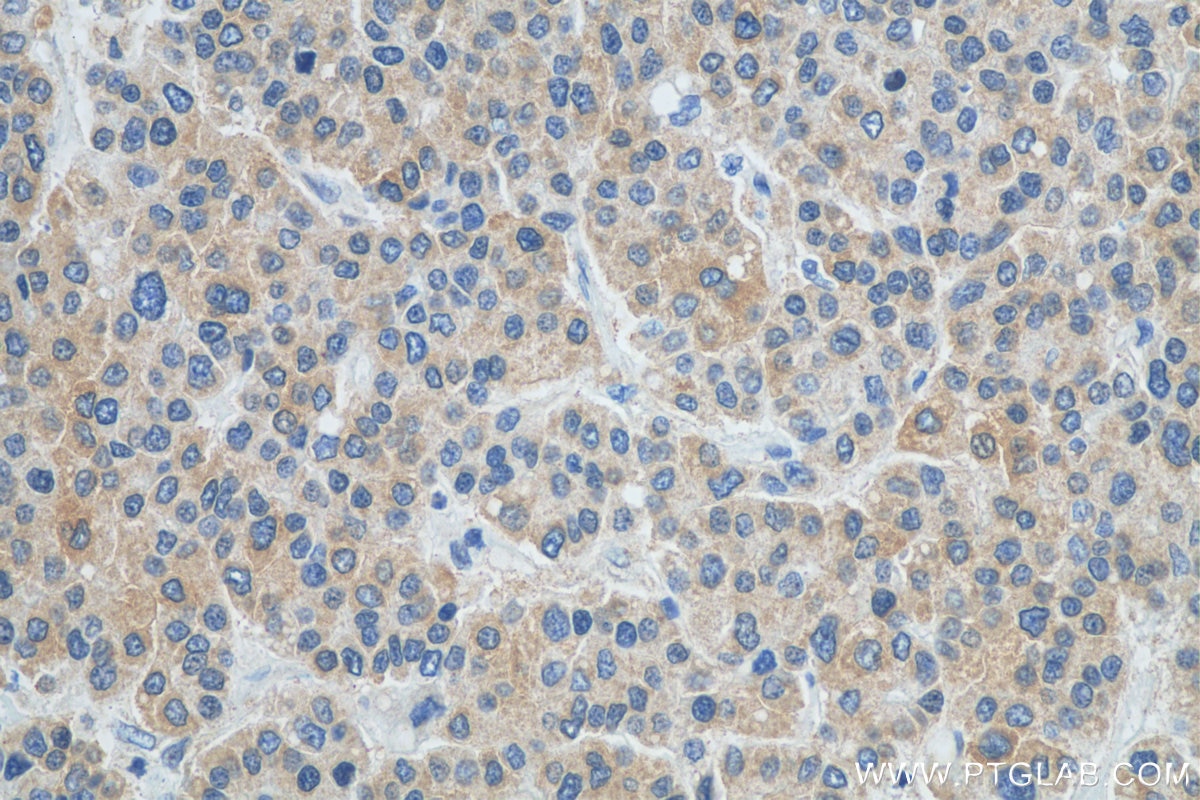 Immunohistochemistry (IHC) staining of human liver cancer tissue using ULK1 Polyclonal antibody (27352-1-AP)