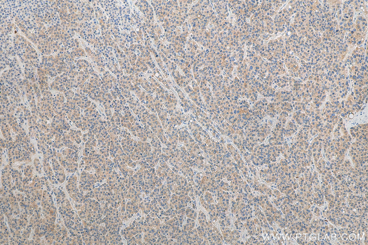 IHC staining of human liver cancer using 27352-1-AP