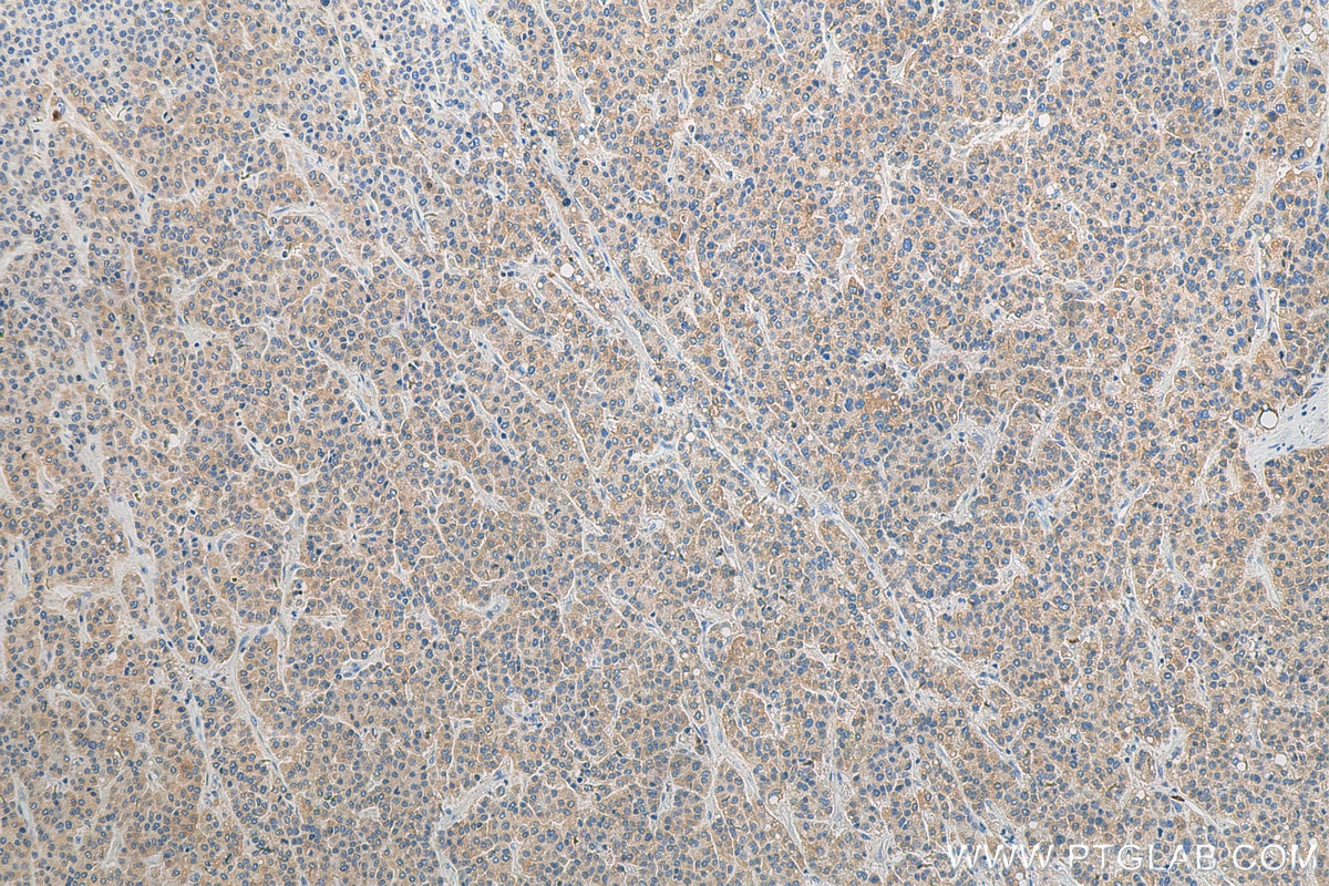 Immunohistochemistry (IHC) staining of human liver cancer tissue using ULK1 Polyclonal antibody (27352-1-AP)