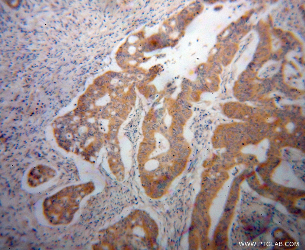 Immunohistochemistry (IHC) staining of human colon cancer tissue using UMPS Polyclonal antibody (14830-1-AP)