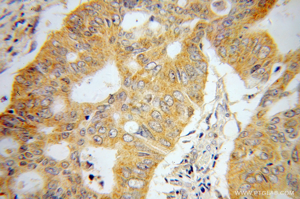 Immunohistochemistry (IHC) staining of human colon cancer tissue using UMPS Polyclonal antibody (14830-1-AP)