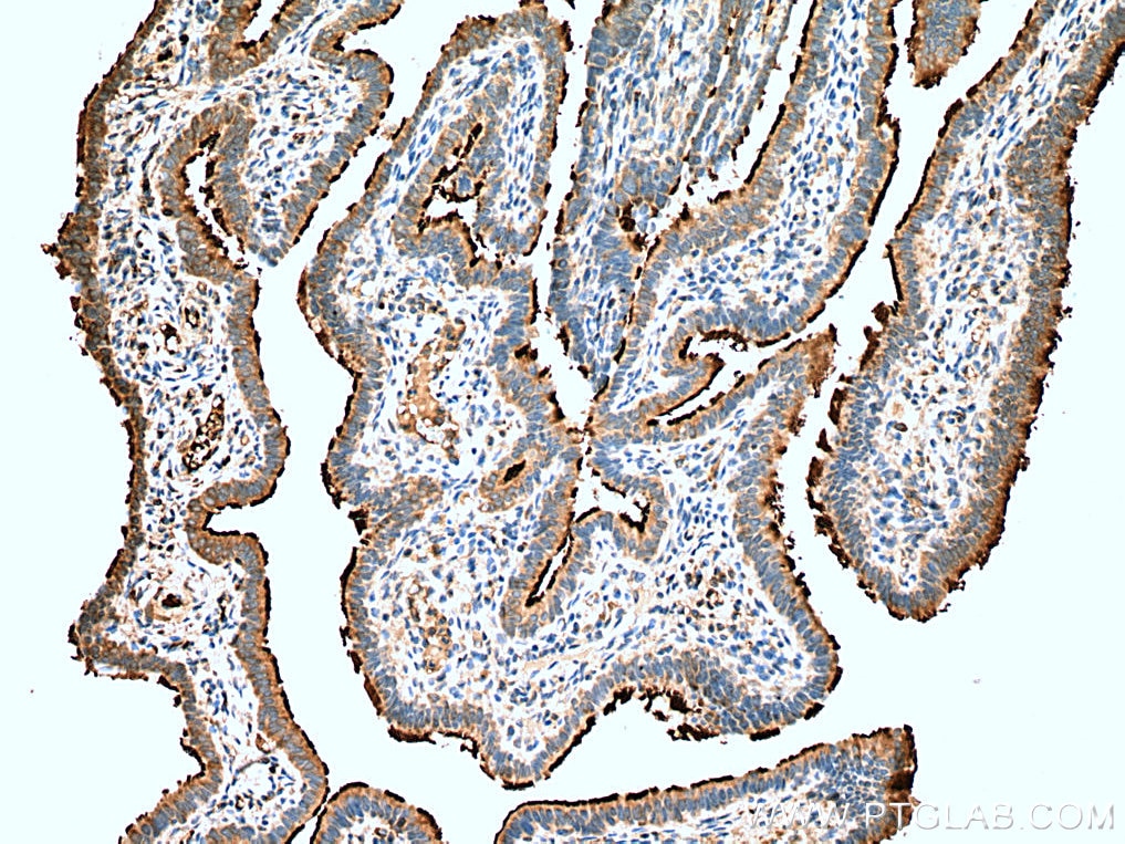 Immunohistochemistry (IHC) staining of human ovary tumor tissue using UNC45A Polyclonal antibody (19564-1-AP)