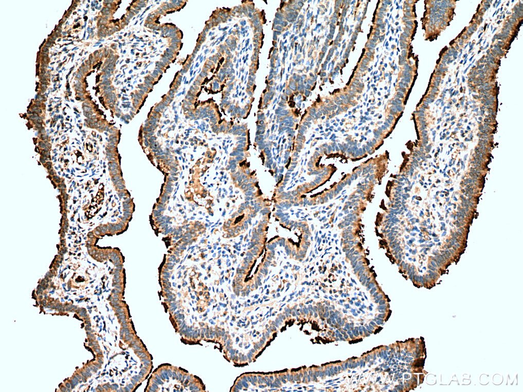 Immunohistochemistry (IHC) staining of human ovary tumor tissue using UNC45A Polyclonal antibody (19564-1-AP)