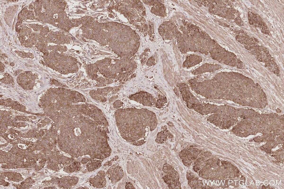 Immunohistochemistry (IHC) staining of human stomach cancer tissue using UNC45A Polyclonal antibody (19564-1-AP)