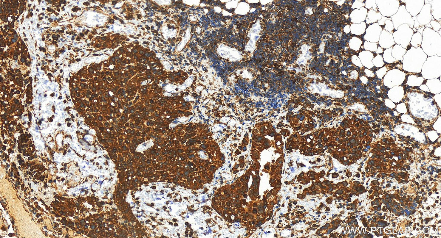 Immunohistochemistry (IHC) staining of human ovary cancer tissue using UNC93B1 Polyclonal antibody (28359-1-AP)