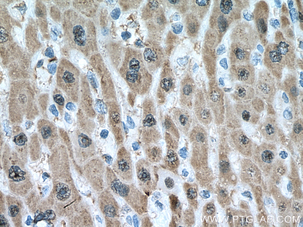 Immunohistochemistry (IHC) staining of human liver cancer tissue using UNG Monoclonal antibody (67490-1-Ig)