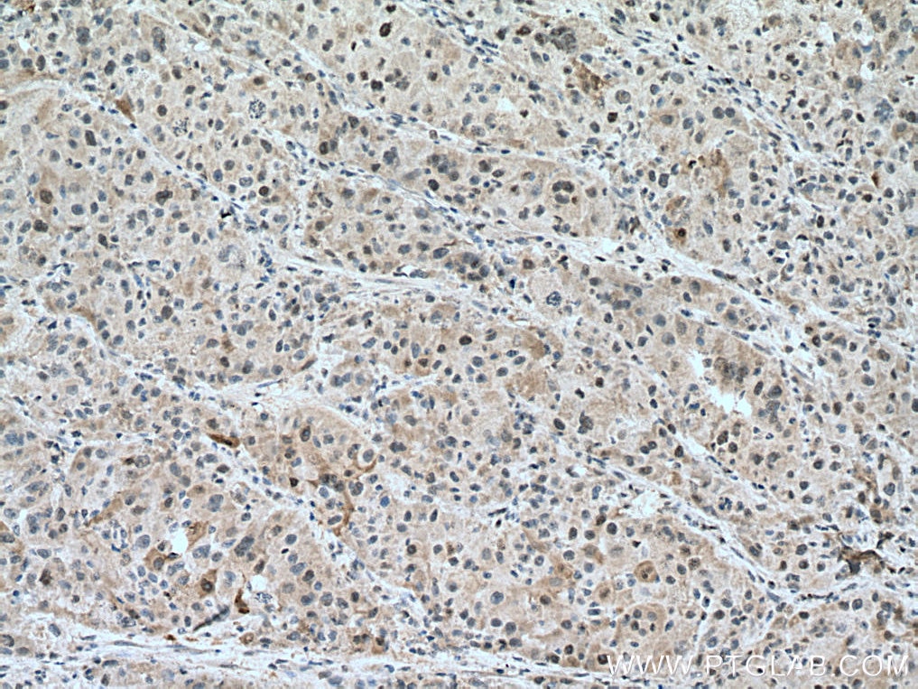 Immunohistochemistry (IHC) staining of human liver cancer tissue using UNG Monoclonal antibody (67490-1-Ig)