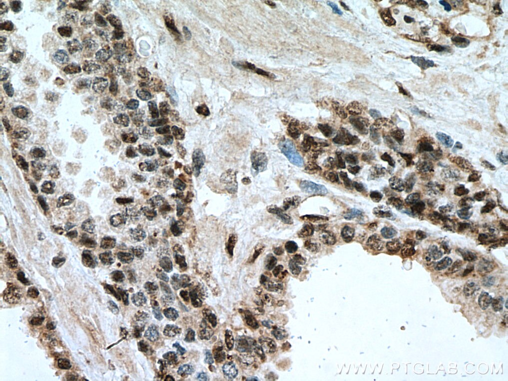 Immunohistochemistry (IHC) staining of human prostate cancer tissue using UNG Monoclonal antibody (67490-1-Ig)