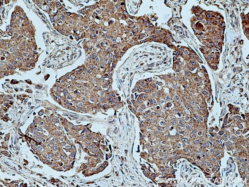 Immunohistochemistry (IHC) staining of human breast cancer tissue using UPF1 Polyclonal antibody (28384-1-AP)