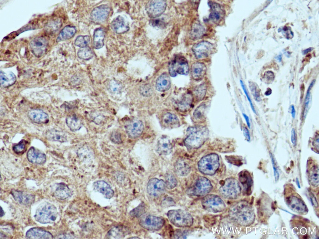 Immunohistochemistry (IHC) staining of human breast cancer tissue using UPF1 Polyclonal antibody (28384-1-AP)