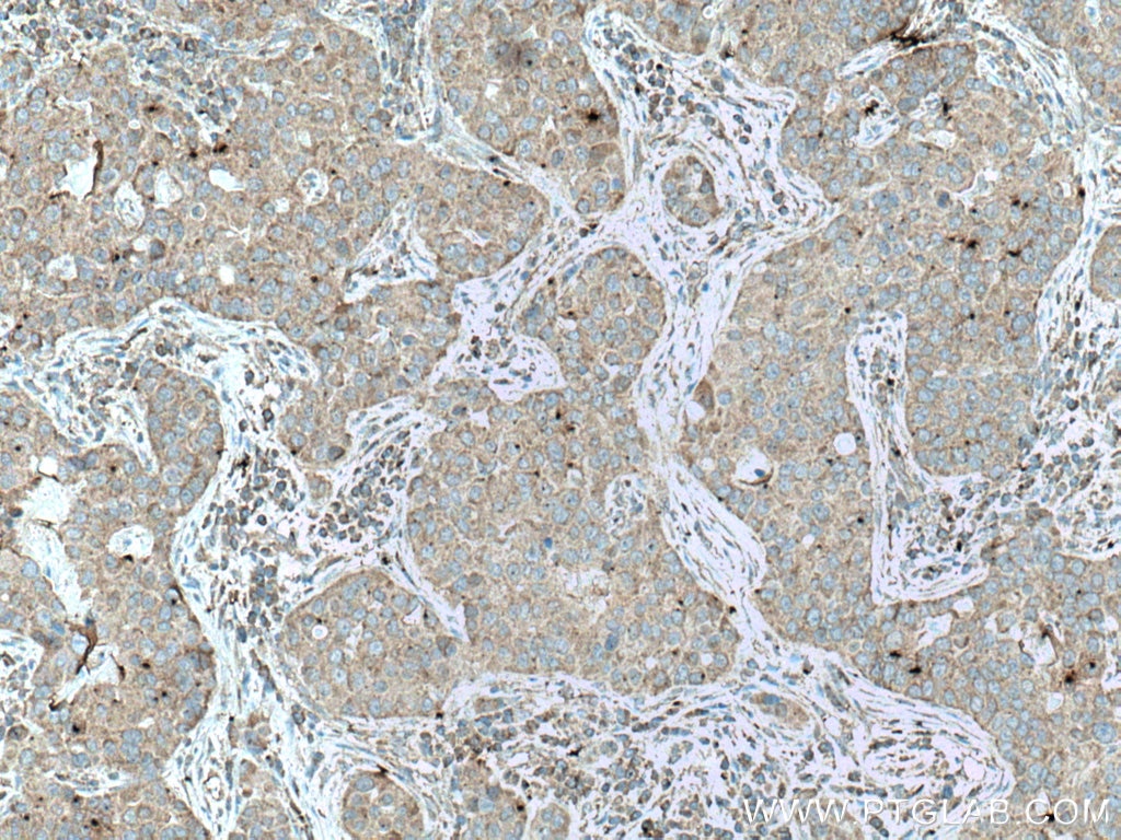 IHC staining of human breast cancer using 66898-1-Ig