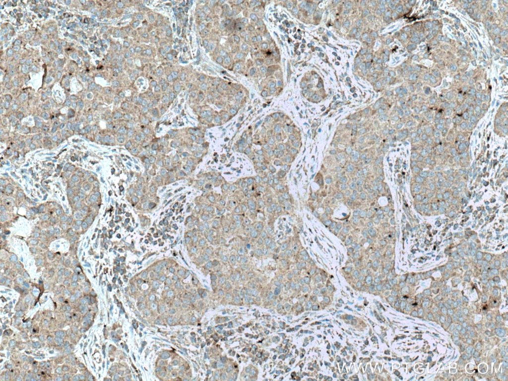 Immunohistochemistry (IHC) staining of human breast cancer tissue using UPF1 Monoclonal antibody (66898-1-Ig)