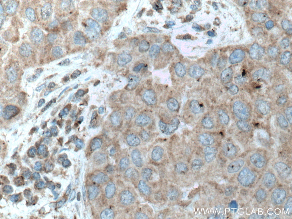 Immunohistochemistry (IHC) staining of human breast cancer tissue using UPF1 Monoclonal antibody (66898-1-Ig)