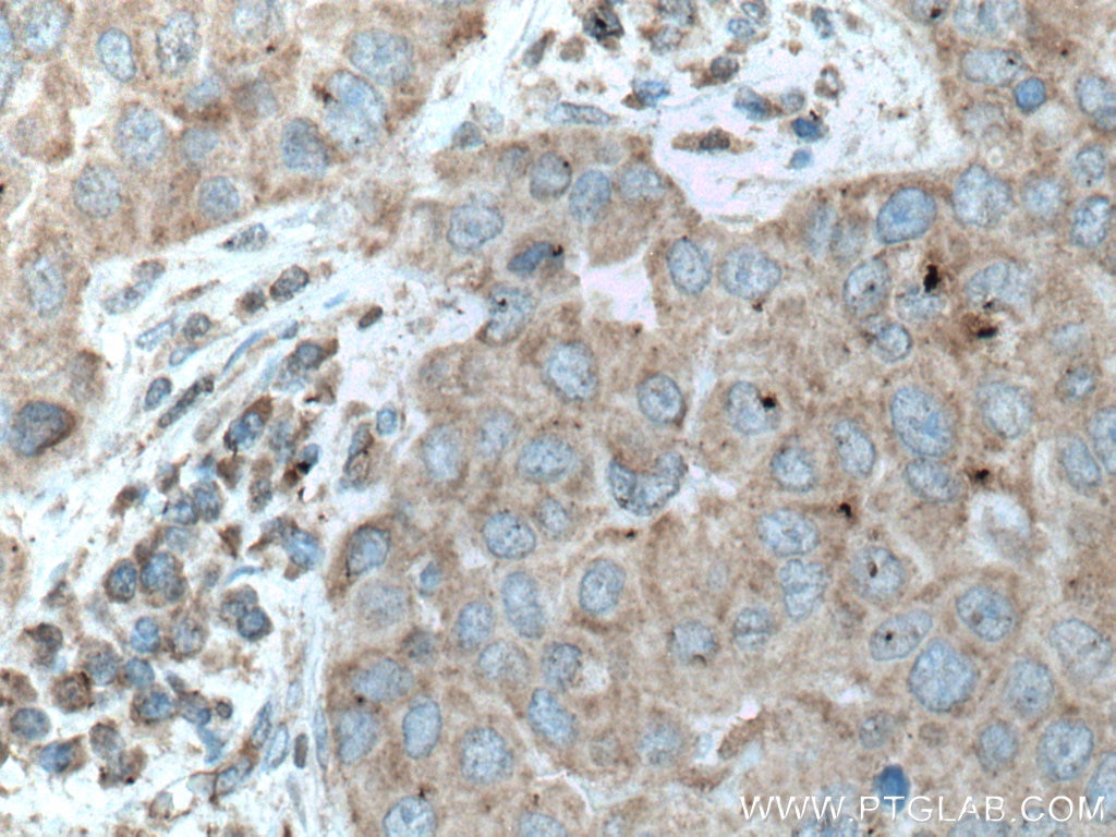 IHC staining of human breast cancer using 66898-1-Ig