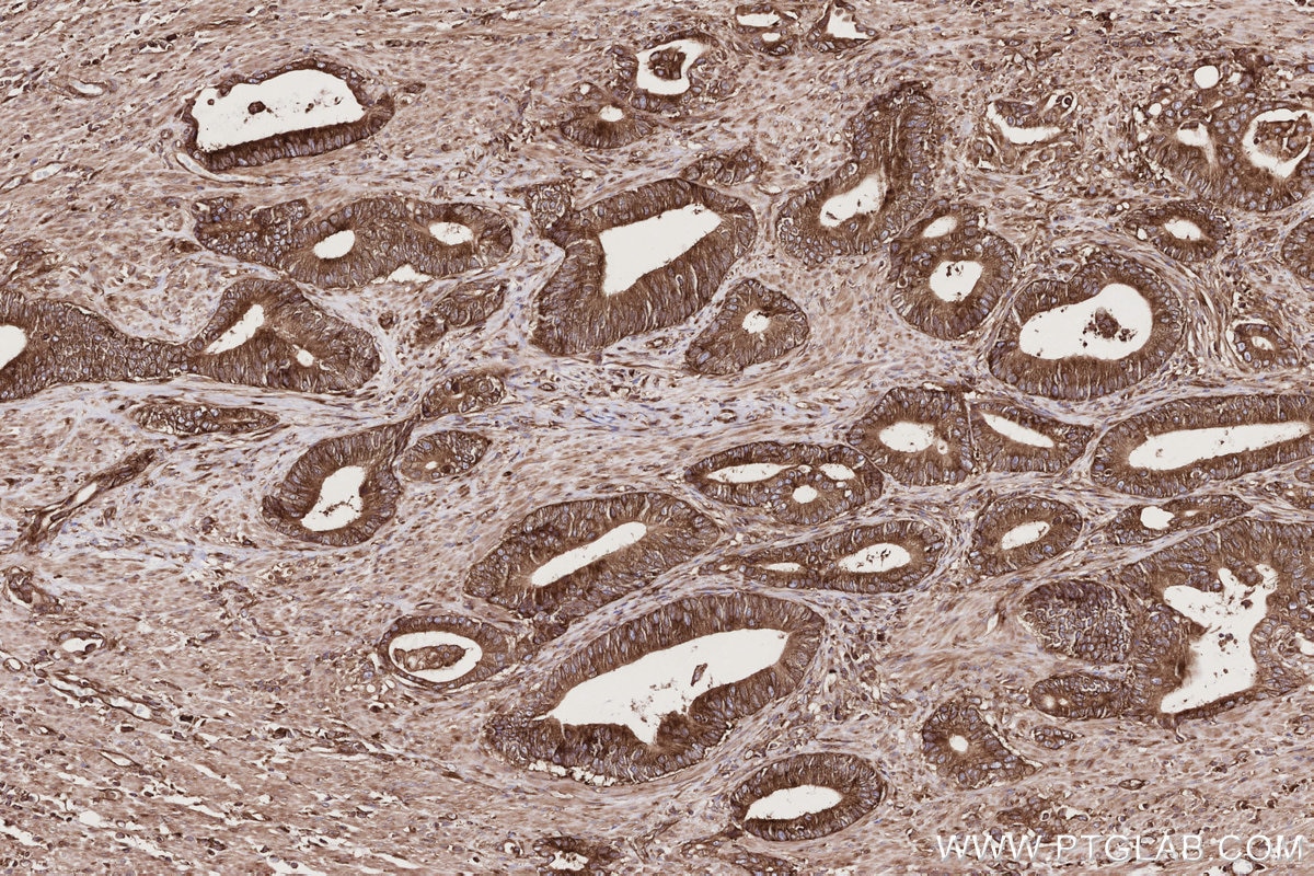 IHC staining of human rectal cancer using 82791-1-RR Immunohistochemistry (IHC) staining of human rectal cancer tissue using UPF1 Recombinant monoclonal antibody (82791-1-RR)