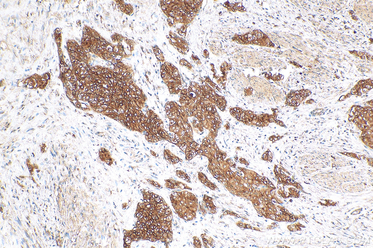 Immunohistochemistry (IHC) staining of human urothelial carcinoma tissue using UPK1B Polyclonal antibody (26853-1-AP)