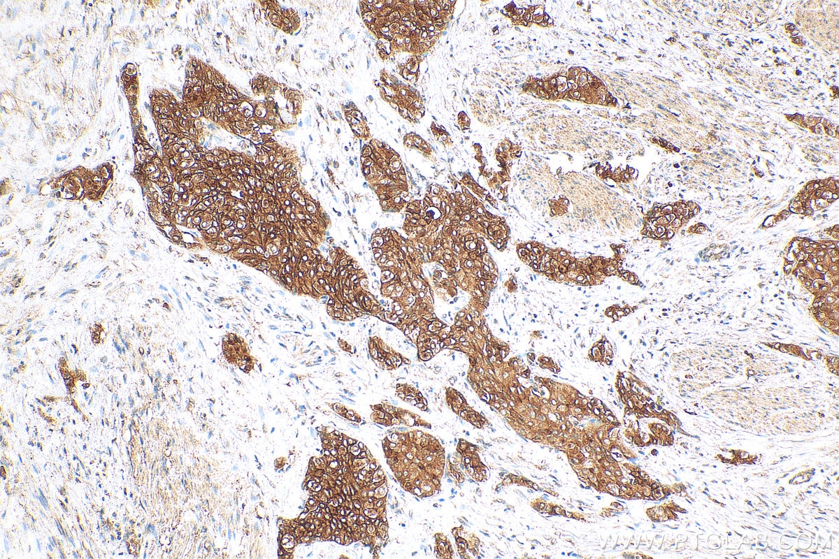 IHC staining of human urothelial carcinoma using 26853-1-AP