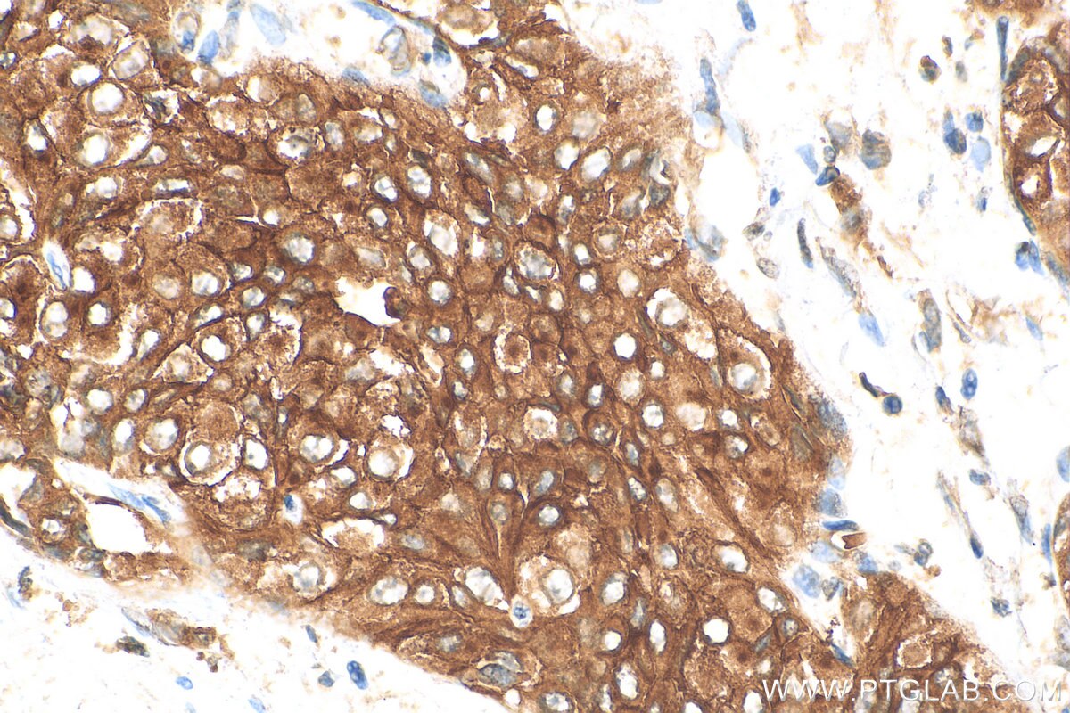 Immunohistochemistry (IHC) staining of human urothelial carcinoma tissue using UPK1B Polyclonal antibody (26853-1-AP)