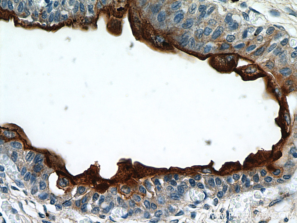 Immunohistochemistry (IHC) staining of human bladder tissue using UPK3B Polyclonal antibody (15709-1-AP)