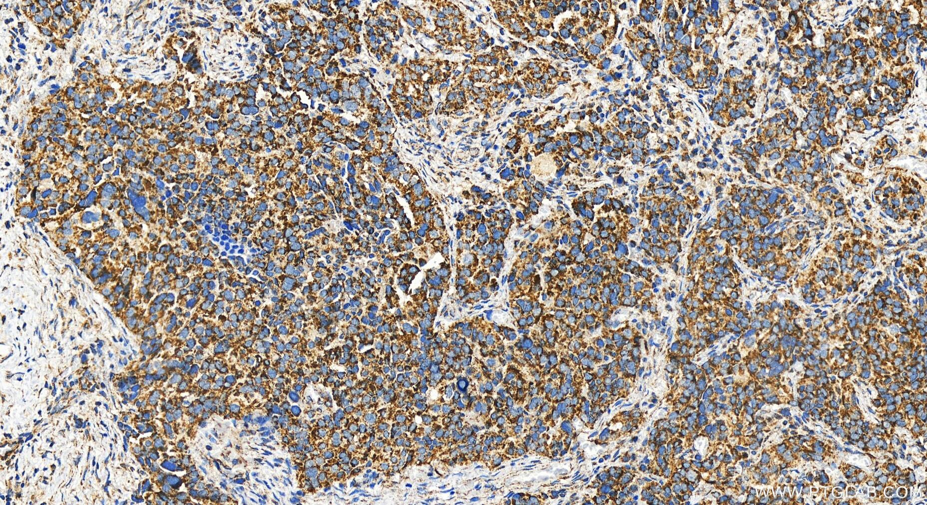 Immunohistochemistry (IHC) staining of human ovary cancer tissue using UQCC Polyclonal antibody (28114-1-AP)