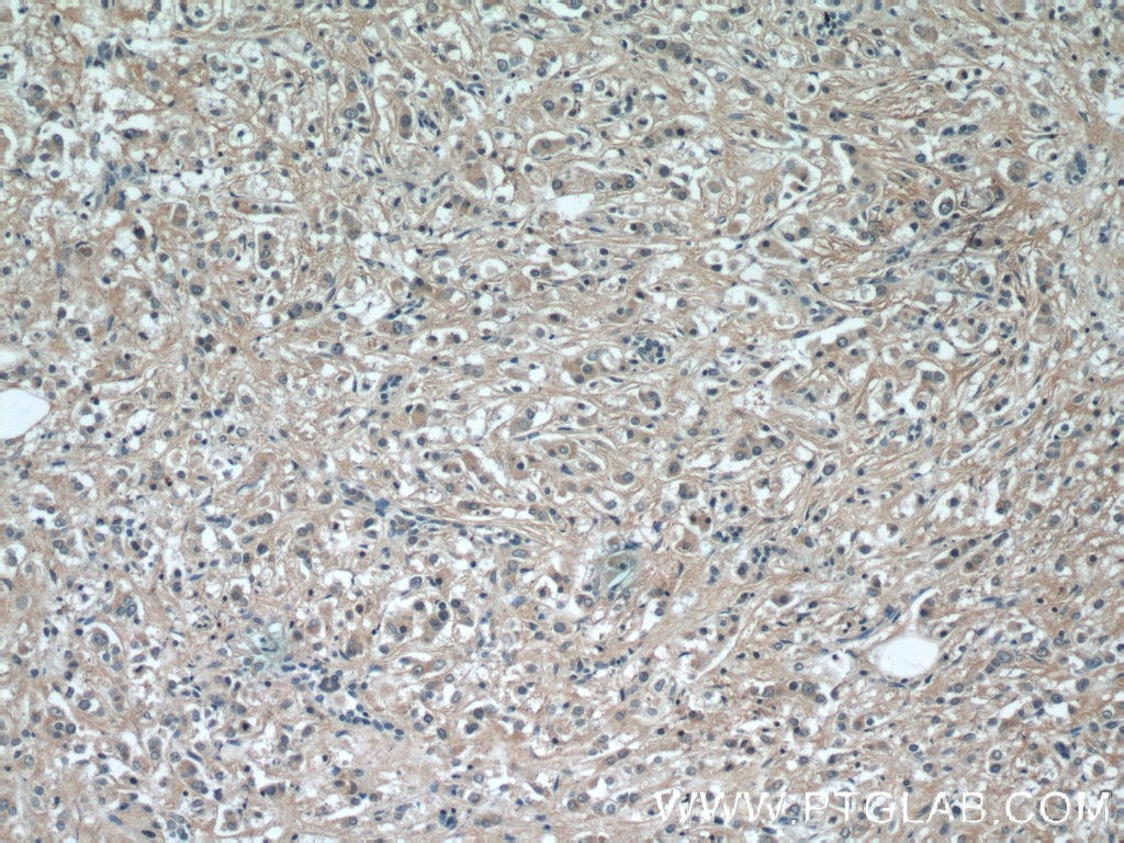 Immunohistochemistry (IHC) staining of human breast cancer tissue using UQCC2 Polyclonal antibody (25781-1-AP)