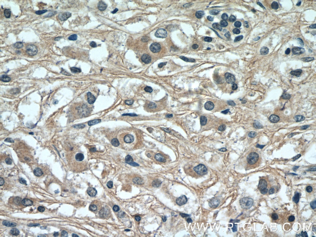Immunohistochemistry (IHC) staining of human breast cancer tissue using UQCC2 Polyclonal antibody (25781-1-AP)