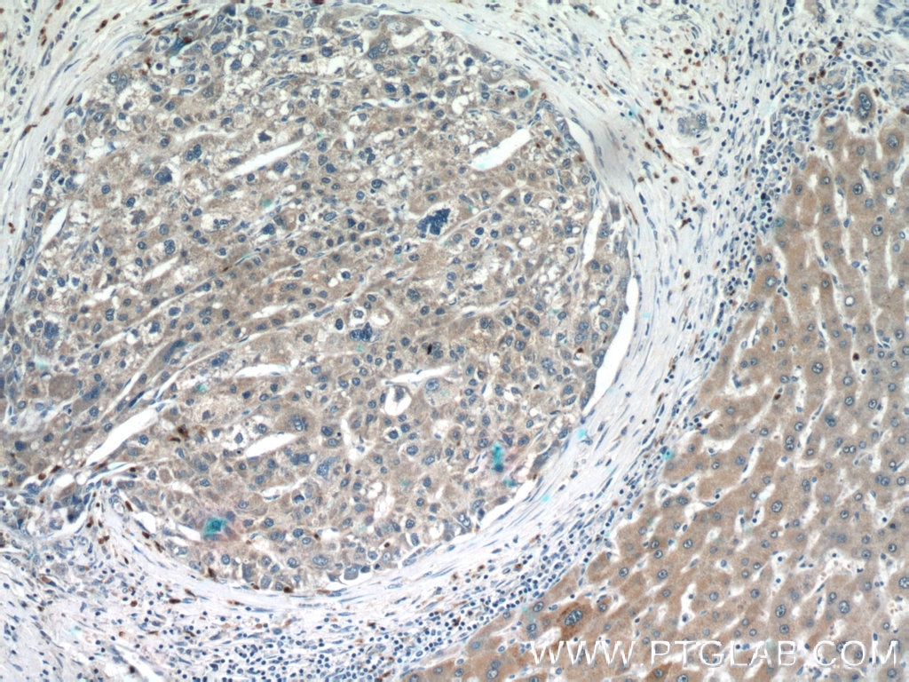 Immunohistochemistry (IHC) staining of human liver cancer tissue using UQCC2 Polyclonal antibody (25781-1-AP)