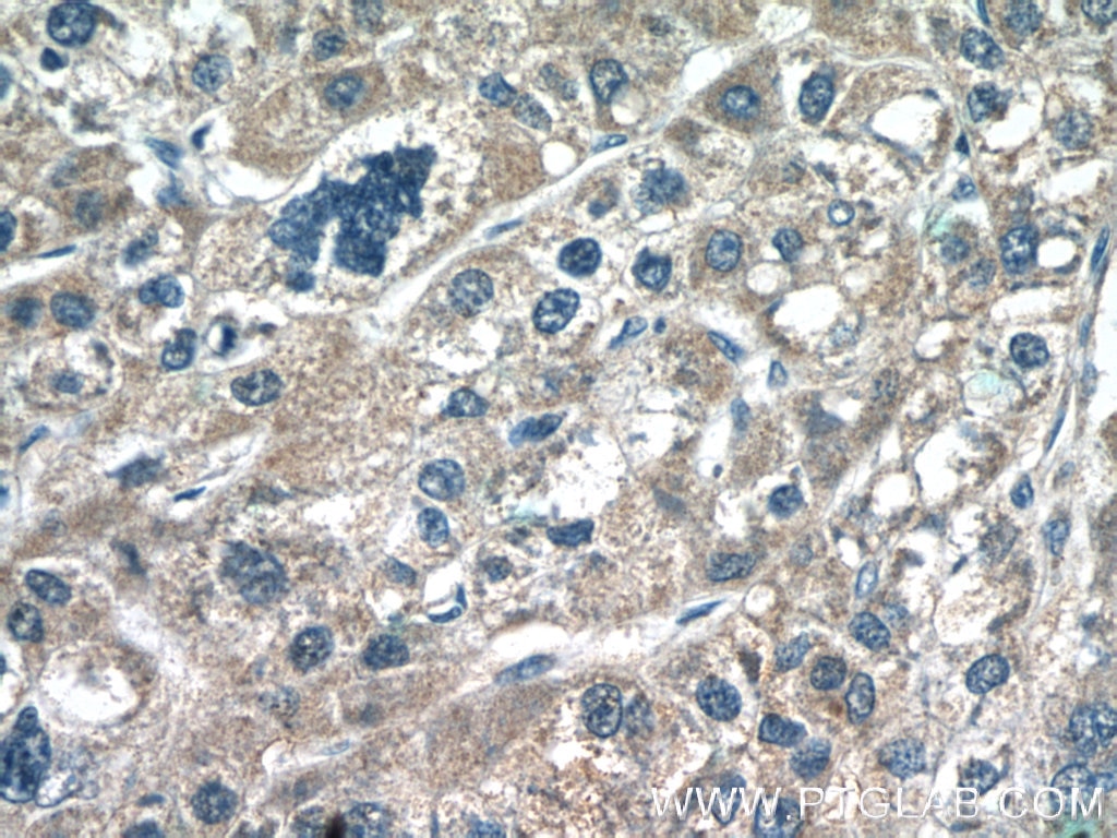 Immunohistochemistry (IHC) staining of human liver cancer tissue using UQCC2 Polyclonal antibody (25781-1-AP)