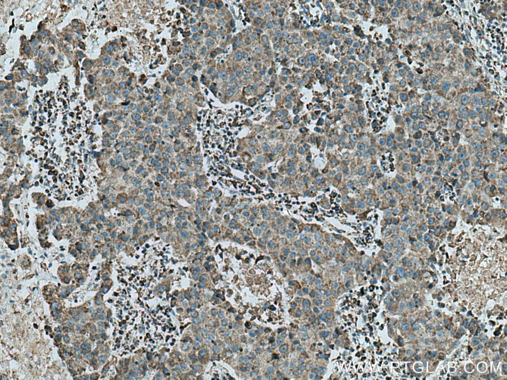 Immunohistochemistry (IHC) staining of human breast cancer tissue using UQCRB Polyclonal antibody (10756-1-AP)