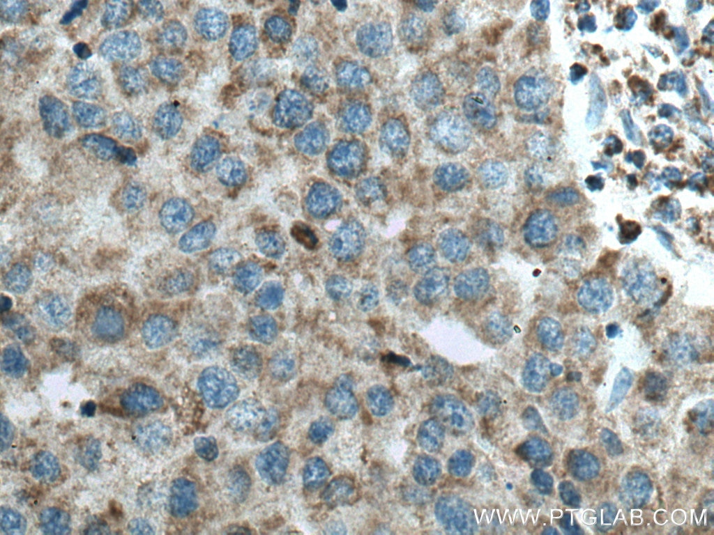 Immunohistochemistry (IHC) staining of human breast cancer tissue using UQCRB Polyclonal antibody (10756-1-AP)