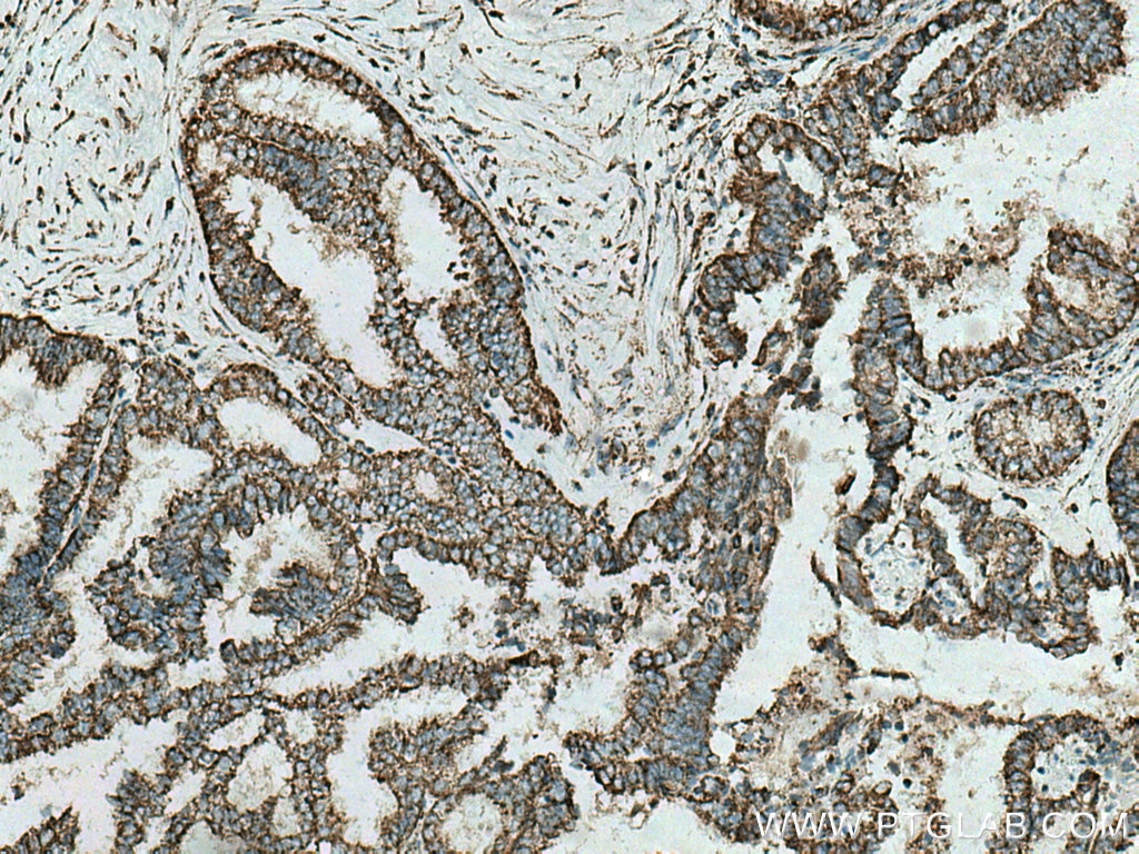 IHC staining of human ovary tumor using 10756-1-AP