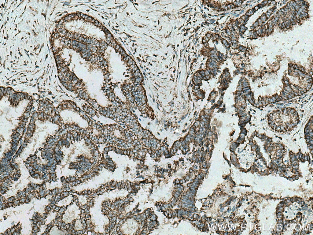Immunohistochemistry (IHC) staining of human ovary tumor tissue using UQCRB Polyclonal antibody (10756-1-AP)