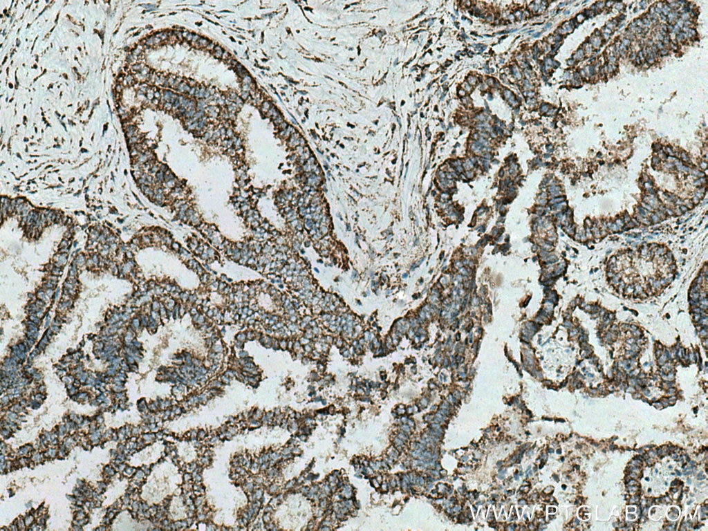 Immunohistochemistry (IHC) staining of human ovary tumor tissue using UQCRB Polyclonal antibody (10756-1-AP)