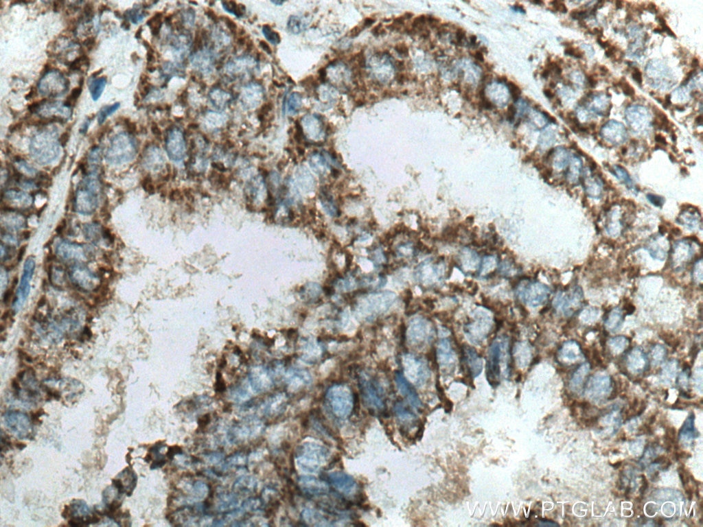 Immunohistochemistry (IHC) staining of human ovary tumor tissue using UQCRB Polyclonal antibody (10756-1-AP)