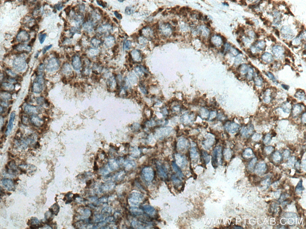 IHC staining of human ovary tumor using 10756-1-AP