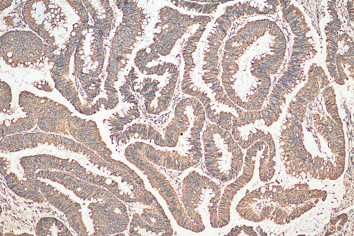 Immunohistochemistry (IHC) staining of human colon cancer tissue using UQCRC2 Polyclonal antibody (14742-1-AP)