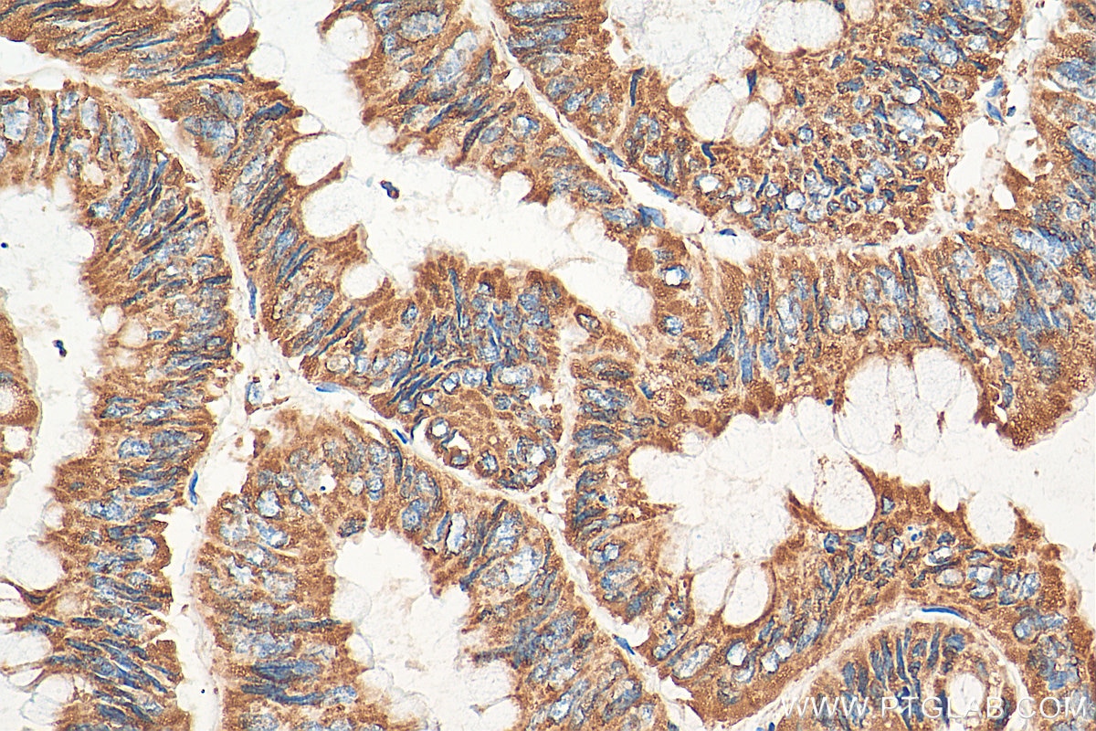 IHC staining of human colon cancer using 14742-1-AP