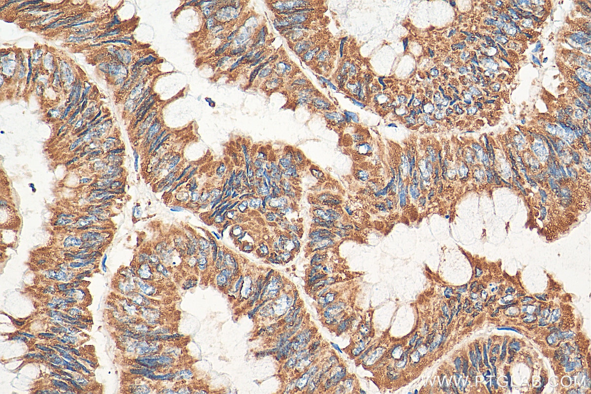 Immunohistochemistry (IHC) staining of human colon cancer tissue using UQCRC2 Polyclonal antibody (14742-1-AP)