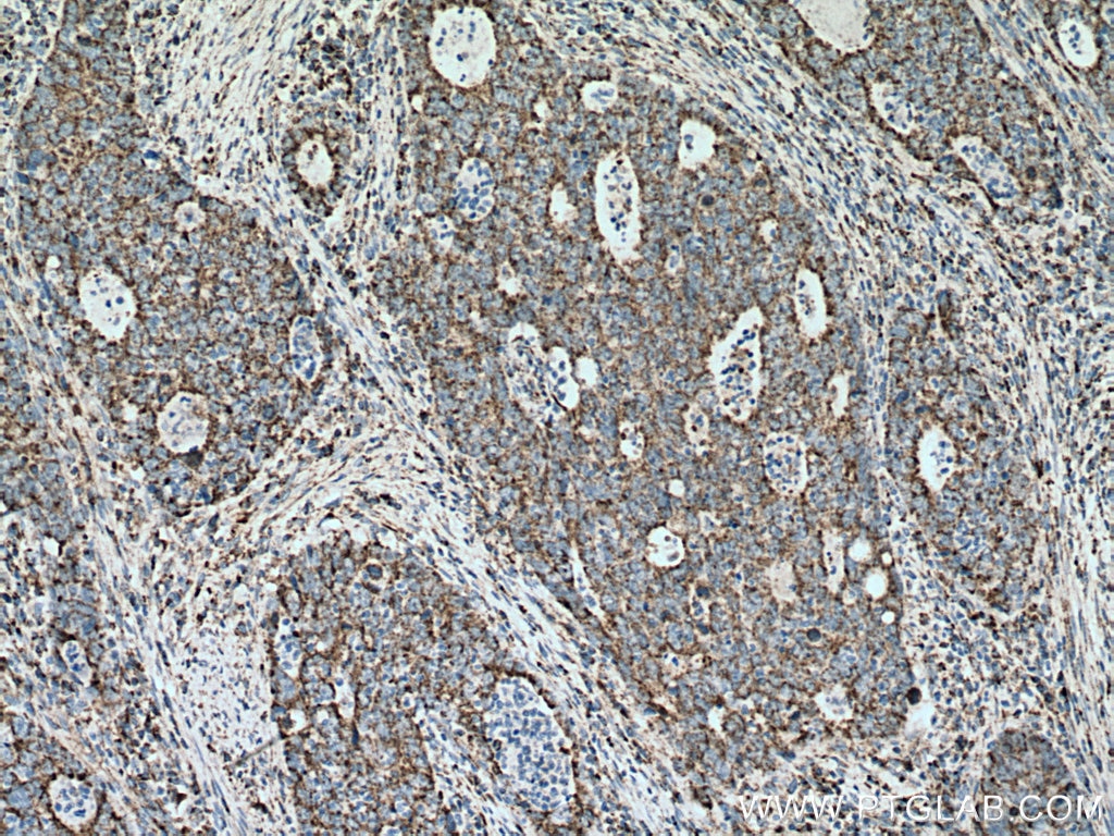 Immunohistochemistry (IHC) staining of human colon cancer tissue using UQCRC2 Monoclonal antibody (67547-1-Ig)
