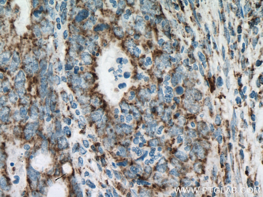 Immunohistochemistry (IHC) staining of human colon cancer tissue using UQCRC2 Monoclonal antibody (67547-1-Ig)