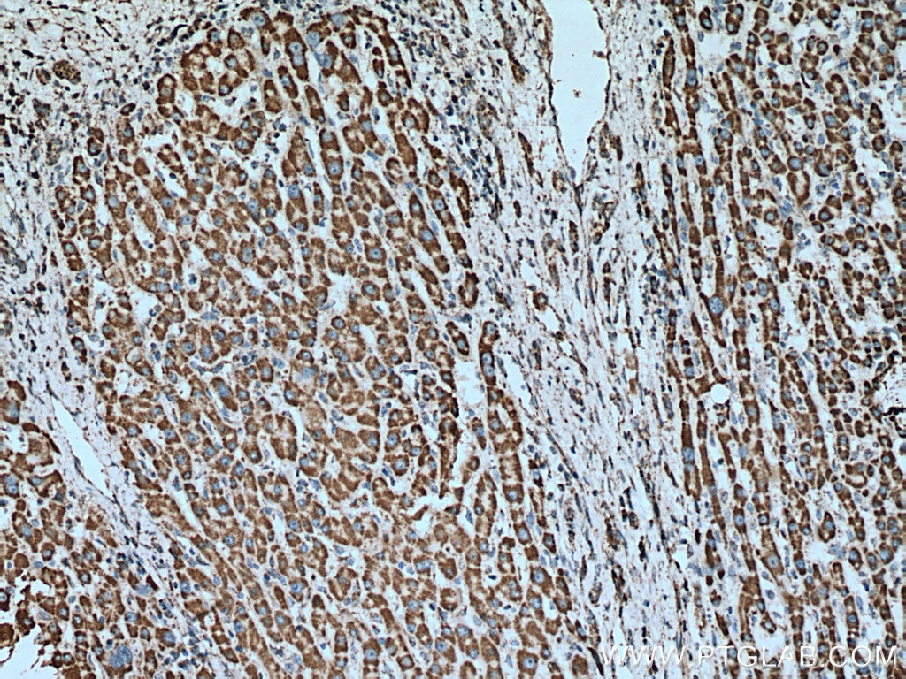 IHC staining of human liver cancer using 67547-1-Ig