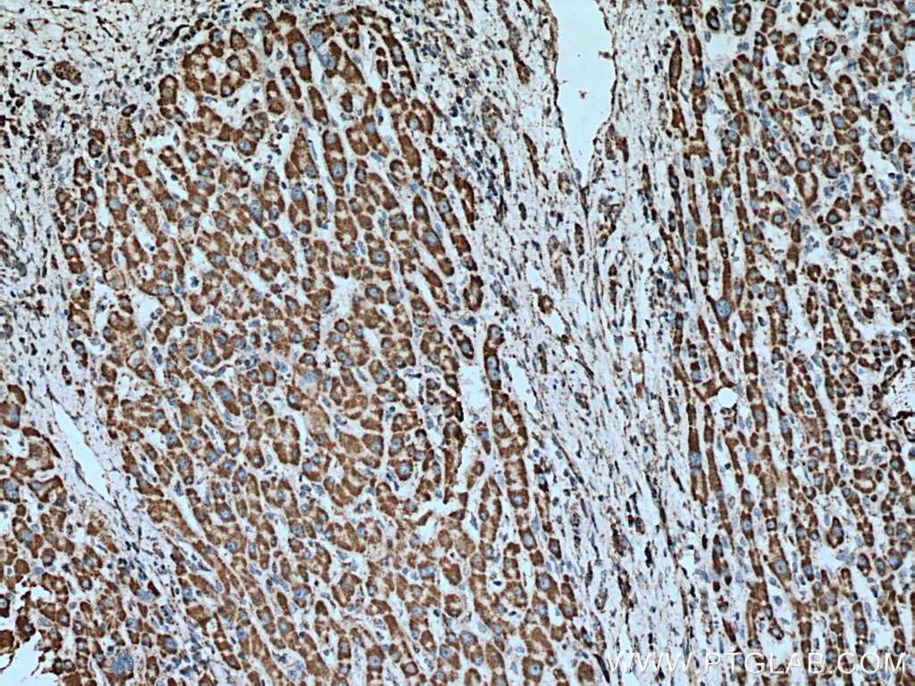 Immunohistochemistry (IHC) staining of human liver cancer tissue using UQCRC2 Monoclonal antibody (67547-1-Ig)